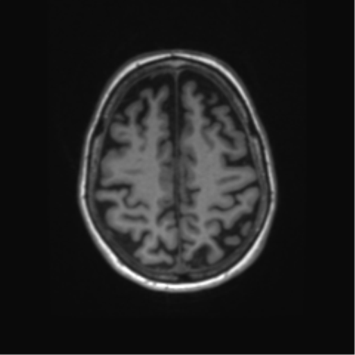 File:Alzheimer's disease (Radiopaedia 42658-45802 Axial T1 43).png