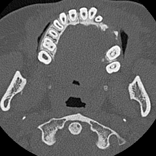 Ameloblastic fibro-odontoma (Radiopaedia 18843-18780 C 48).jpg