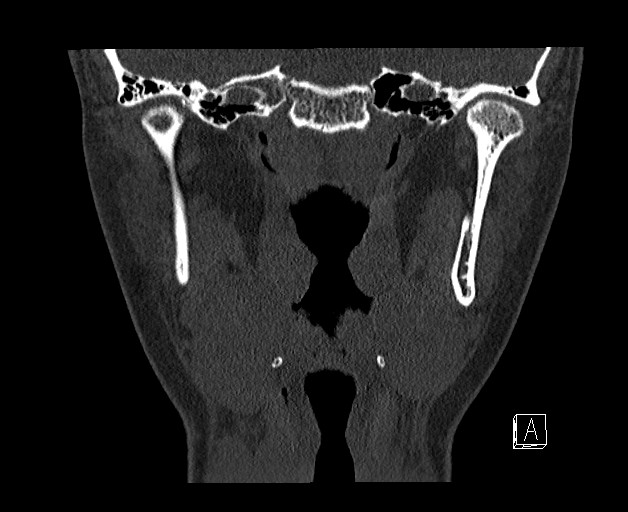 File:Ameloblastoma (Radiopaedia 26645-26793 bone window 21).jpg