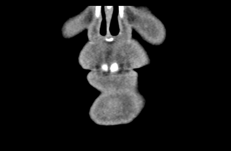 Ameloblastoma (Radiopaedia 33677-34806 Coronal non-contrast 11).png