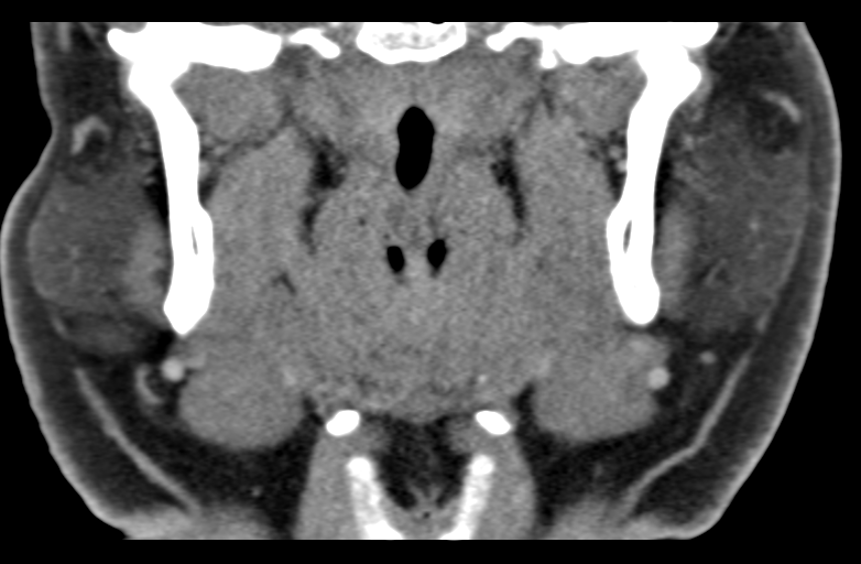 Ameloblastoma (Radiopaedia 33677-34806 Coronal non-contrast 37).png