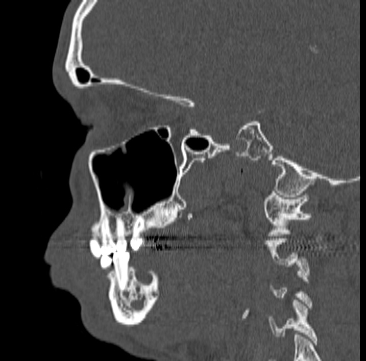Ameloblastoma (Radiopaedia 77750-89997 Sagittal bone window 27).jpg