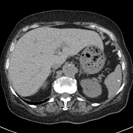 File:Amiodarone-induced pulmonary fibrosis (Radiopaedia 82355-96460 Axial non-contrast 57).jpg