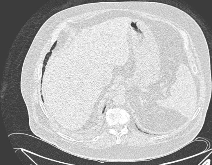 File:Amiodarone lung (Radiopaedia 62514-70769 Axial lung window 80).jpg