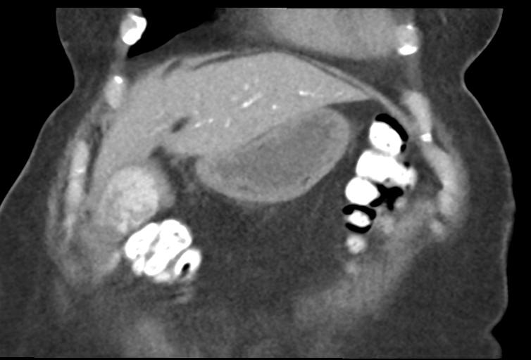 Ampullary adenocarcinoma (Radiopaedia 34013-35241 Coronal 10).png