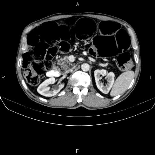 Ampullary adenocarcinoma (Radiopaedia 86093-102032 A 22).jpg