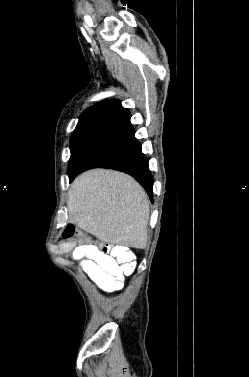Ampullary adenocarcinoma (Radiopaedia 86093-102033 E 8).jpg