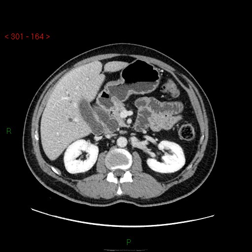 Ampullary carcinoma (Radiopaedia 56396-63056 C 37).jpg