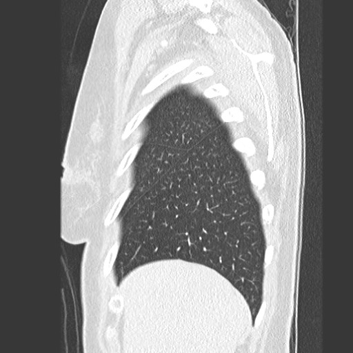 File:Amyloidosis - bronchial and diffuse nodular pulmonary involvement (Radiopaedia 60156-67745 Sagittal lung window 11).jpg