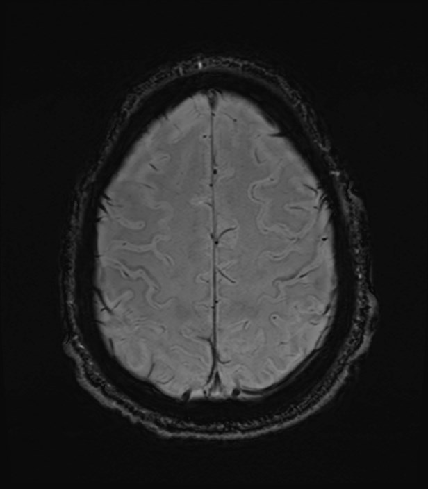 Amyotrophic lateral sclerosis (Radiopaedia 87352-103658 Axial SWI 52).jpg