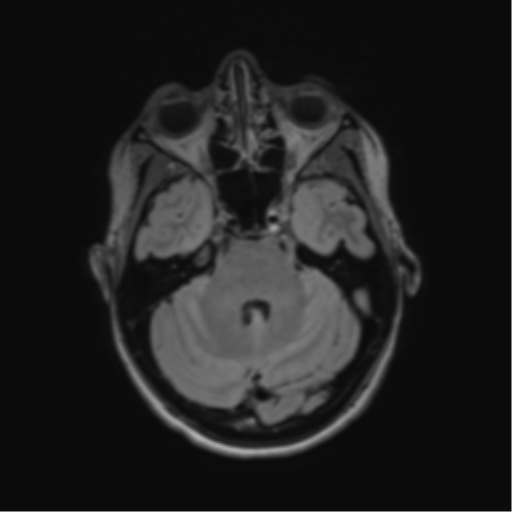 File:Anaplastic astrocytoma IDH mutant (Radiopaedia 50046-55341 Axial FLAIR 15).png