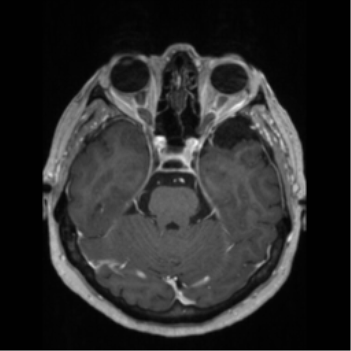 File:Anaplastic astrocytoma IDH wild-type (pseudoprogression) (Radiopaedia 42209-45276 Axial T1 C+ 54).png