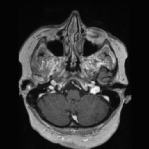 File:Anaplastic astrocytoma IDH wild-type (pseudoprogression) (Radiopaedia 42209-45278 Axial T1 C+ 37).png