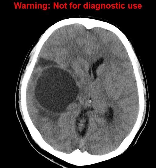 File:Anaplastic ganglioglioma (Radiopaedia 44921-48815 Axial non-contrast 13).jpg