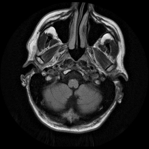 File:Anaplastic meningioma with recurrence (Radiopaedia 34452-35790 Axial T2 FLAIR 2).png