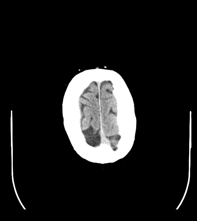 Anaplastic oligodendroglioma (Radiopaedia 79571-92755 Axial non-contrast 49).jpg