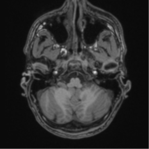 Anaplastic oligodendroglioma with skull fracture (Radiopaedia 74831-85845 Axial T1 8).png