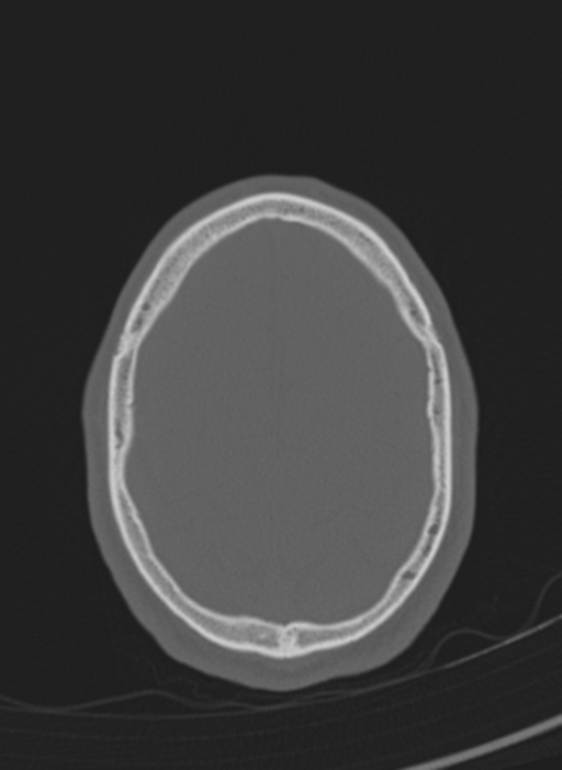 Anaplastic oligodendroglioma with skull fracture (Radiopaedia 74831-85846 Axial bone window 3).png