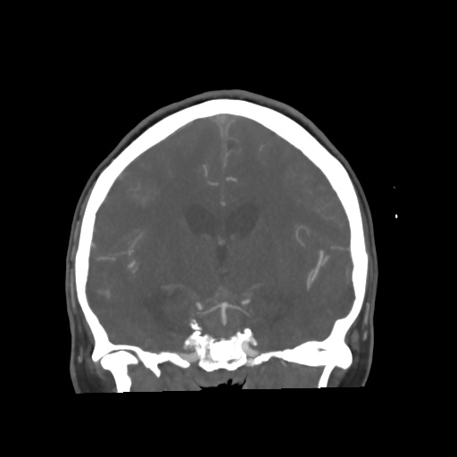 Aneursym related subarachnoid hemorrhage with hydrocephalus (Radiopaedia 45105-49084 B 41).jpg