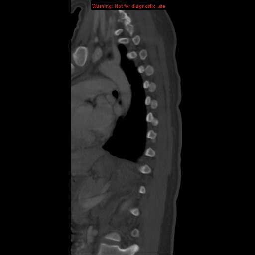 File:Aneurysmal bone cyst (Radiopaedia 9419-10102 Sagittal bone window 16).jpg