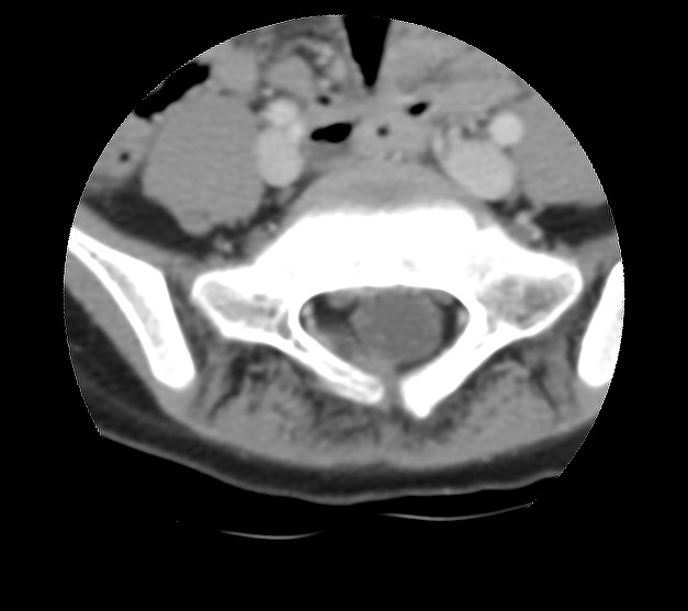 Aneurysmal bone cyst - sacrum (Radiopaedia 65190-74195 Axial non-contrast 16).jpg