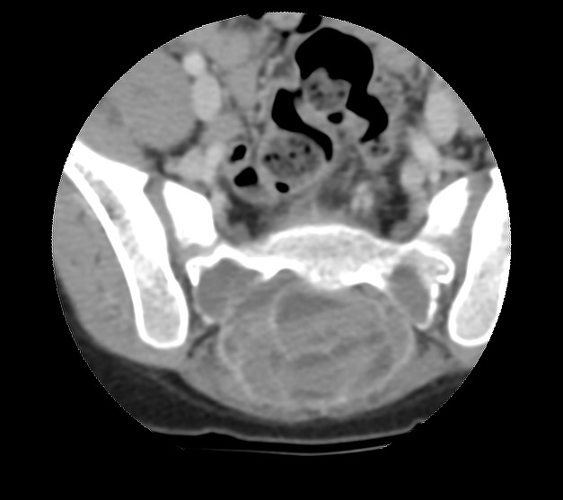 Aneurysmal bone cyst - sacrum (Radiopaedia 65190-74195 Axial non-contrast 24).jpg