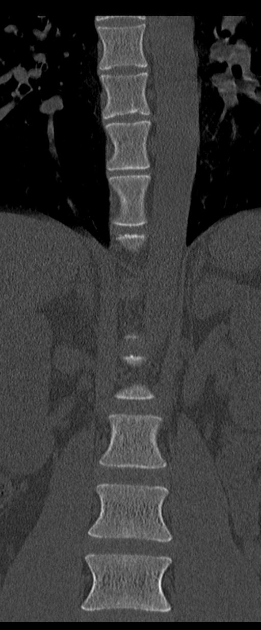 Aneurysmal bone cyst T11 (Radiopaedia 29294-29721 Coronal bone window 16).jpg