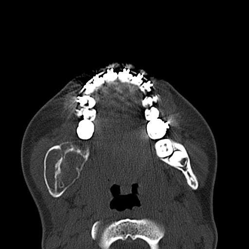 File:Aneurysmal bone cyst of the mandible (Radiopaedia 43280-46601 Axial bone window 32).jpg