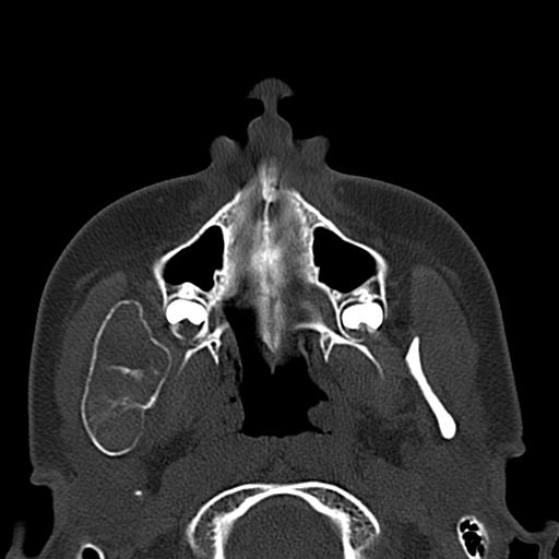Aneurysmal bone cyst of the mandible (Radiopaedia 43280-46601 Axial bone window 57).jpg