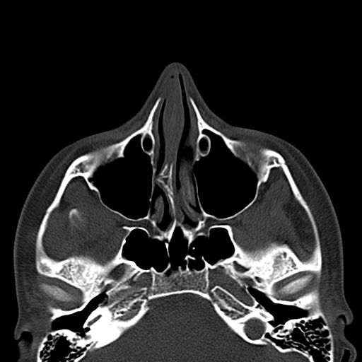 Aneurysmal bone cyst of the mandible (Radiopaedia 43280-46601 Axial bone window 79).jpg