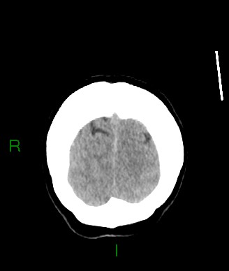 Aneurysmal subarachnoid hemorrhage with intra-axial extension (Radiopaedia 84371-99699 Coronal non-contrast 10).jpg