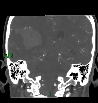 Aneurysmal subarachnoid hemorrhage with intra-axial extension (Radiopaedia 84371-99732 C 42).jpg