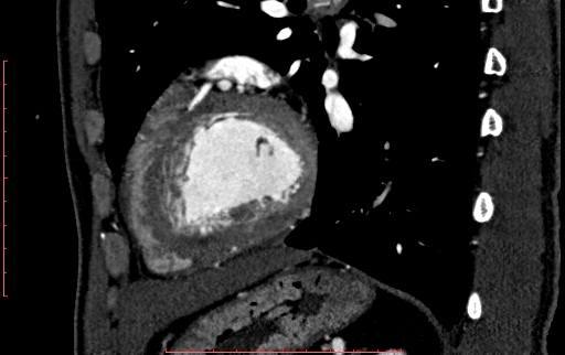 File:Anomalous left coronary artery from the pulmonary artery (ALCAPA) (Radiopaedia 70148-80181 C 183).jpg