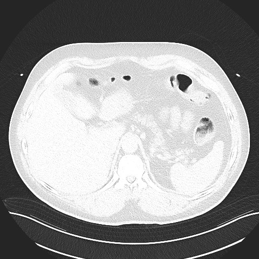File:Anomalous origin of the left coronary artery with malignant course (Radiopaedia 77842-90126 Axial lung window 34).jpeg