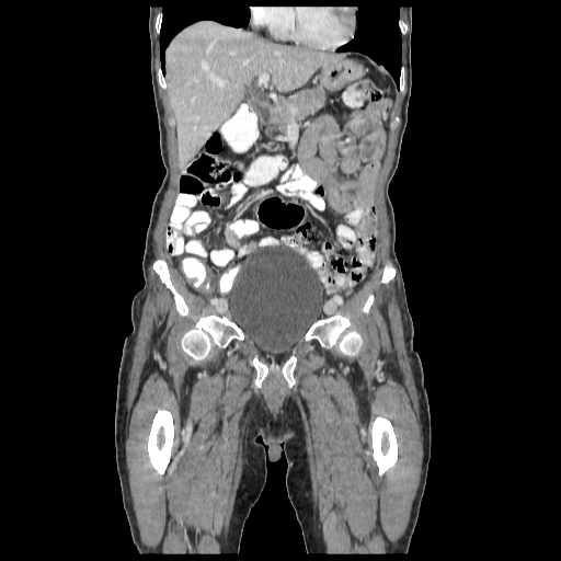 Anorectal carcinoma (Radiopaedia 44413-48064 B 22).jpg
