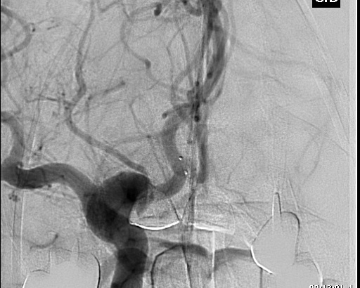 File:Anterior cerebral artery aneurysm (Radiopaedia 80683-94130 A 4).jpg