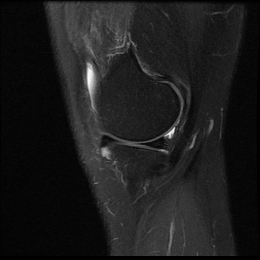 File:Anterior cruciate ligament avulsion fracture (Radiopaedia 58939-66193 Sagittal PD fat sat 17).jpg