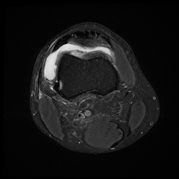 File:Anterior cruciate ligament graft tear and bucket-handle tear of medial meniscus (Radiopaedia 75867-87255 Axial PD fat sat 20).jpg