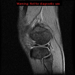 File:Anterior cruciate ligament injury - partial thickness tear (Radiopaedia 12176-12515 A 16).jpg