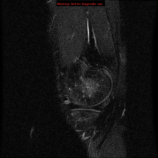 File:Anterior cruciate ligament injury - partial thickness tear (Radiopaedia 12176-12515 Sagittal T2 fat sat 3).jpg
