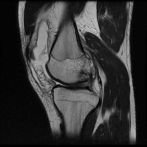 File:Anterior cruciate ligament tear (Radiopaedia 61500-69462 Sagittal T2 7).jpg