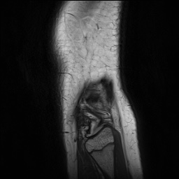 Anterior cruciate ligament tear - pediatric (Radiopaedia 62152-70260 Sagittal PD 159).jpg