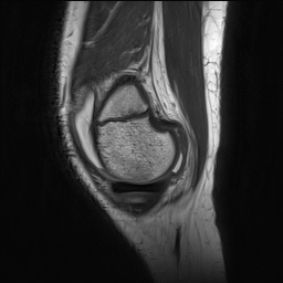 Anterior cruciate ligament tear - pediatric (Radiopaedia 62152-70260 Sagittal PD 34).jpg