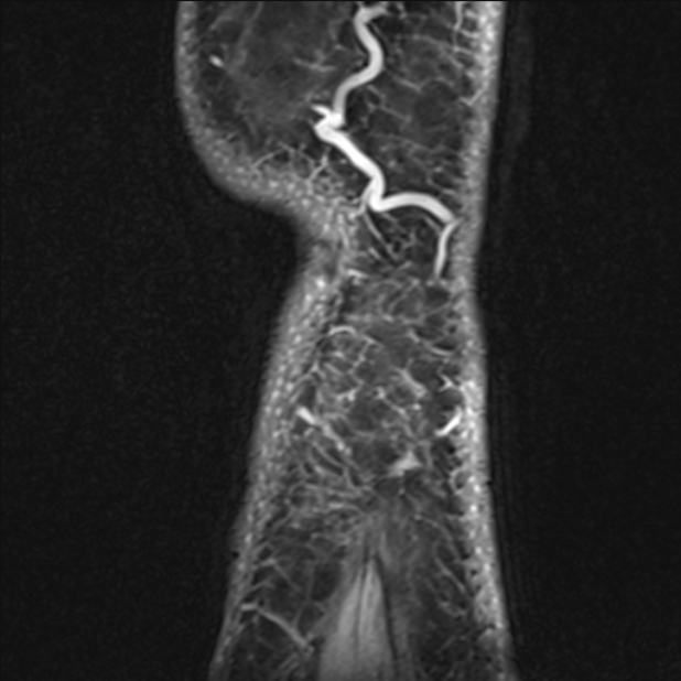 Anterior cruciate ligament tear - ramp lesion (Radiopaedia 71883-82322 Sagittal T1 vibe 6).jpg