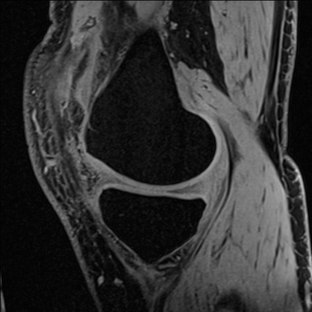 Anterior cruciate ligament tear - ramp lesion (Radiopaedia 71883-82322 Sagittal T1 vibe 98).jpg