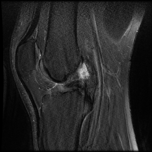File:Anterior cruciate ligament tear with posteromedial corner injury, bucket-handle meniscal tear and chondral delamination (Radiopaedia 75501-86744 Sagittal PD fat sat 15).jpg