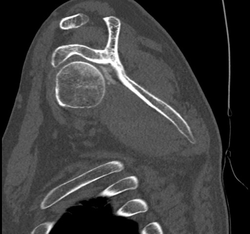 Anterior glenohumeral dislocation with Hill-Sachs lesion (Radiopaedia 62877-71249 Sagittal bone window 36).jpg