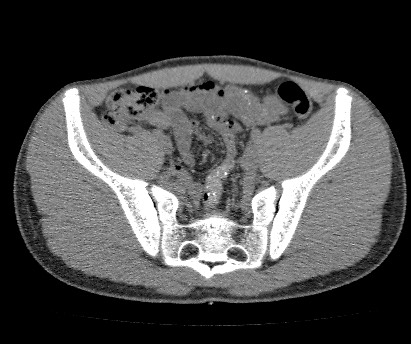 File:Anterior inferior iliac spine avulsion fracture (Radiopaedia 81312-94999 Axial non-contrast 33).jpg