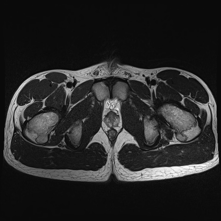 File:Anterior inferior iliac spine avulsion fracture (Radiopaedia 81312-95000 Axial T2 9).jpg