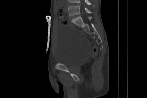 Anterior inferior iliac spine avulsion injury (Radiopaedia 88666-105376 Sagittal bone window 46).jpg